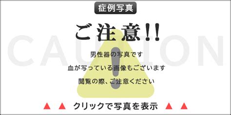 亀頭増大 銀座|包茎手術・包茎治療は認定専門医の元で！ [東京・大。